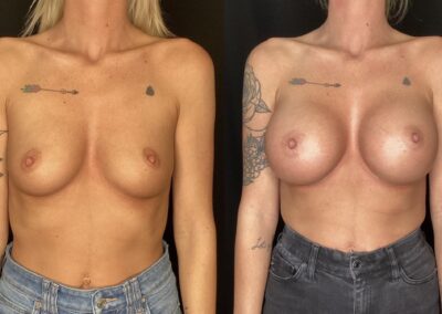 Breast Augmentation before and after photo