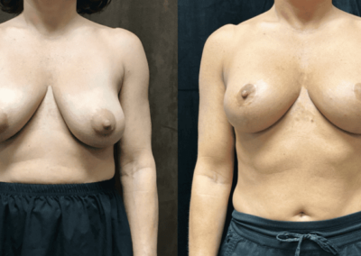 Breast Lift (Mastopexy) before and after photo