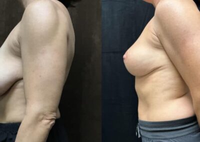 Breast Lift (Mastopexy) before and after photo