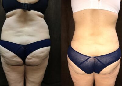 Tummy Tuck before and after photo