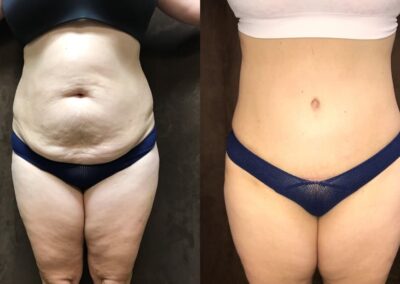 Tummy Tuck before and after photo