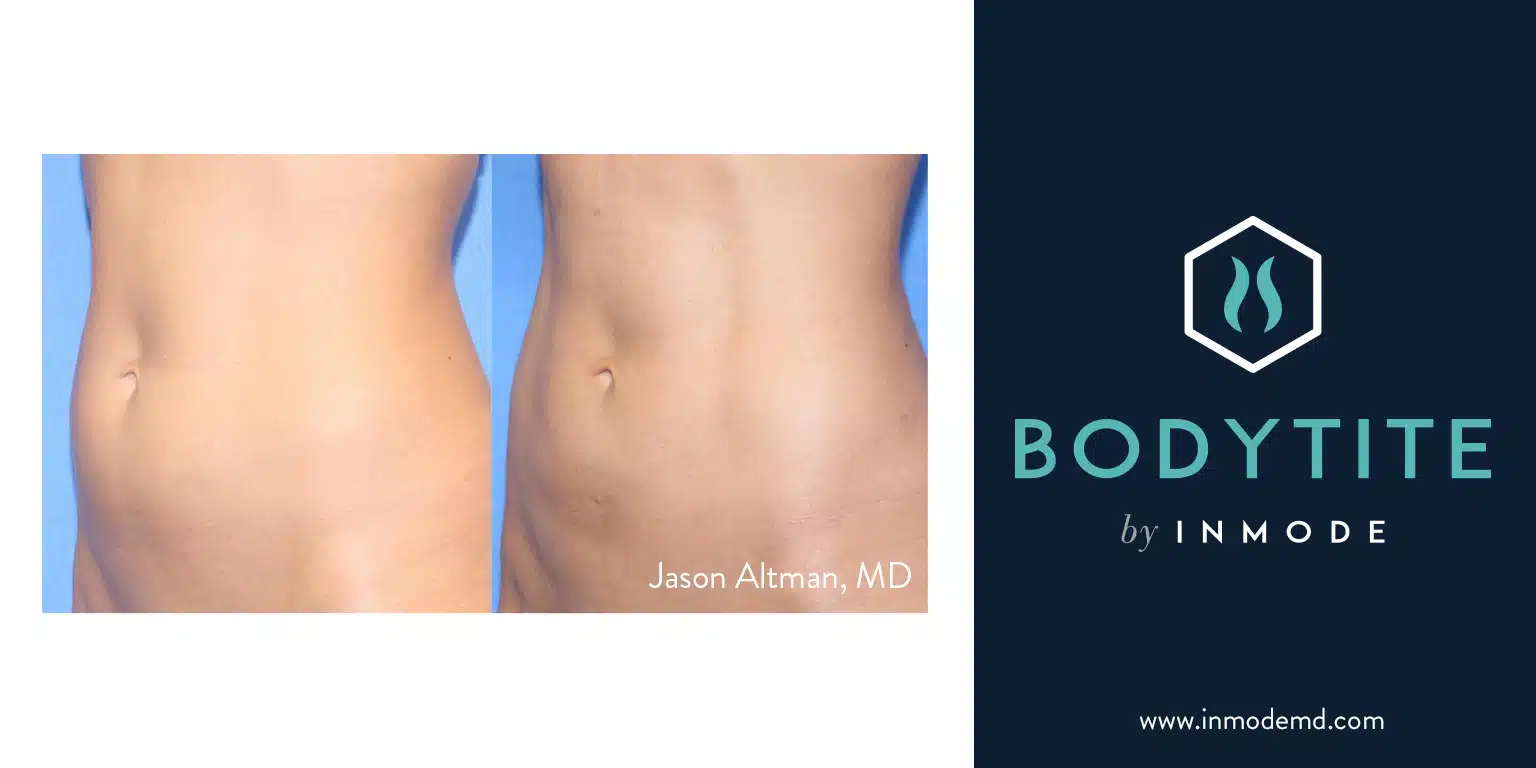 BodyTite before and after photo
