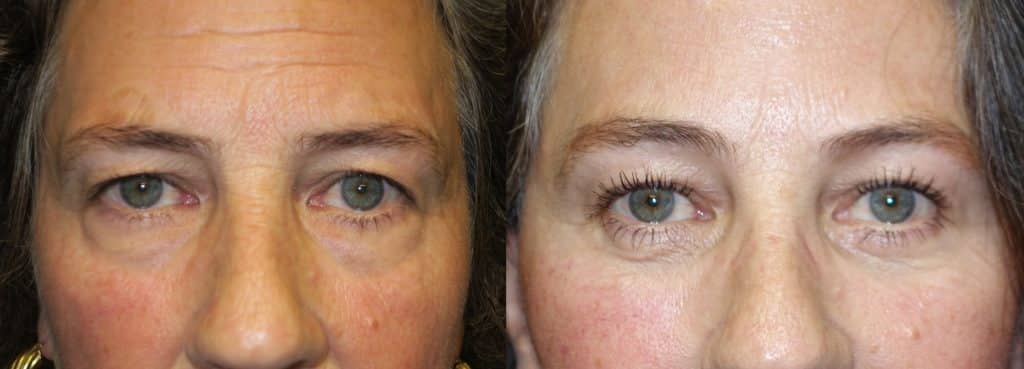 brow lift before and after photo brow lift before and after photo
