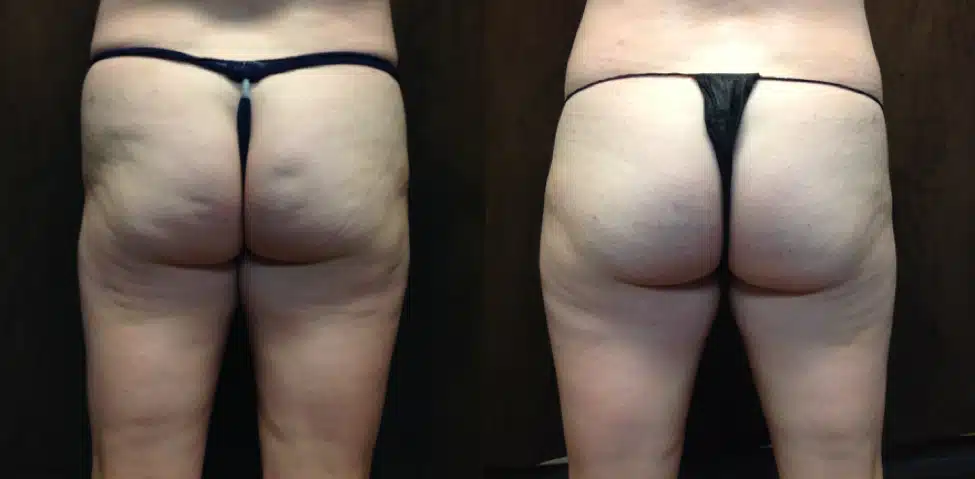 Cellulite treatment before and after photo by Fort Worth Plastic Surgery in Fort Worth, TX