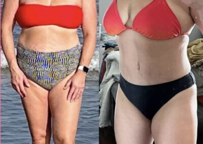Tummy Tuck before and after photo