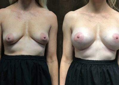 Breast Augmentation before and after photo