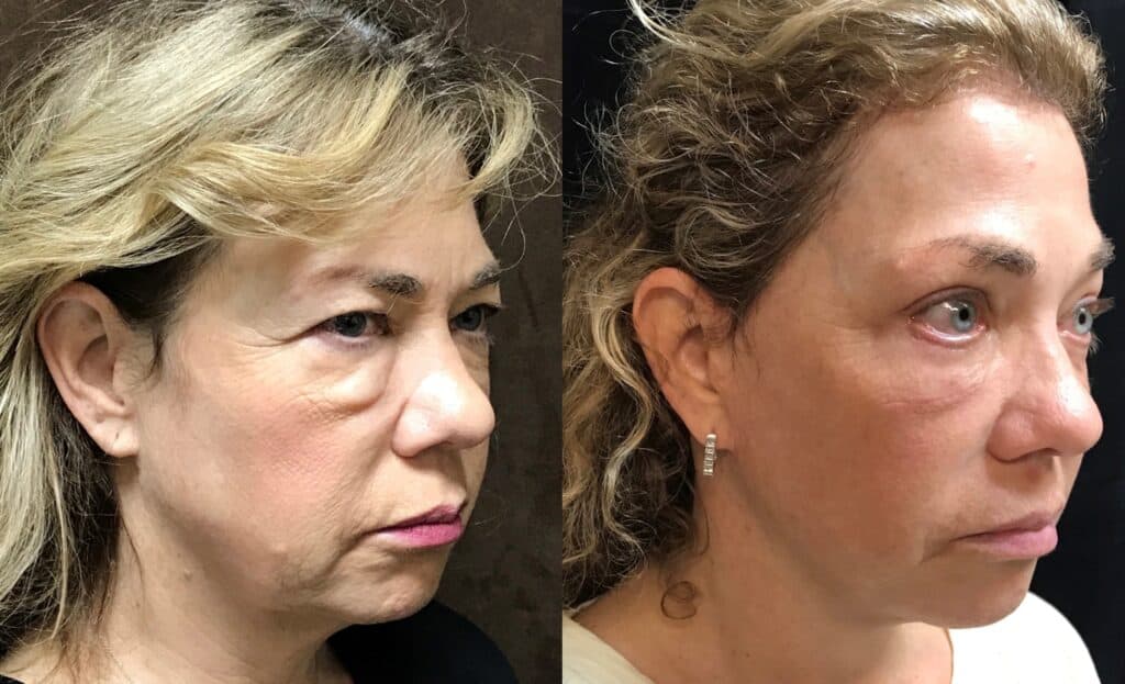 Facelift before and after photos