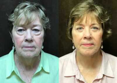 Neck Lift before and after photos