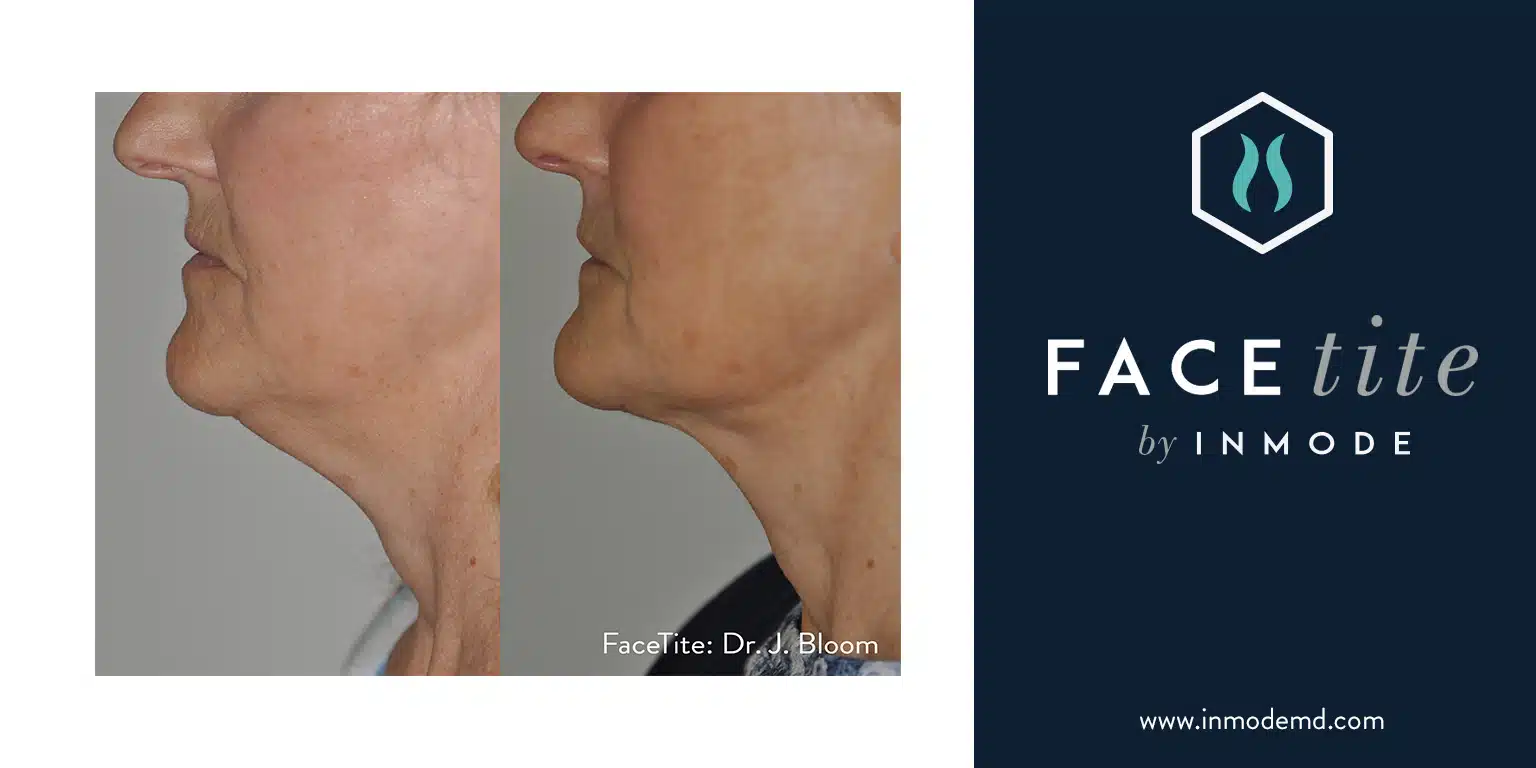 FaceTite before and after photo