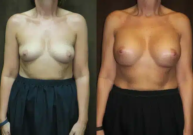 front view breast augmentation before and after photo by fort worth plastic surgery in fort worth tx