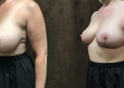 Breast Lift (Mastopexy) before and after photo