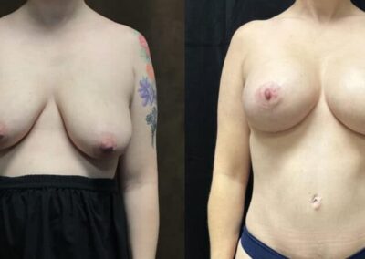 Mommy Makeover before and after photo