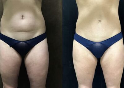 Mommy Makeover before and after photo