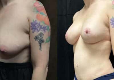 Mommy Makeover before and after photo