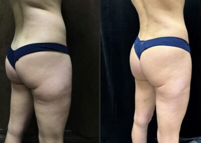 Mommy Makeover before and after photo