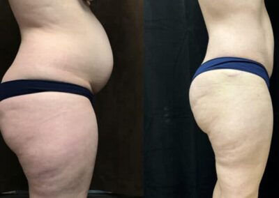 Mommy Makeover before and after photo