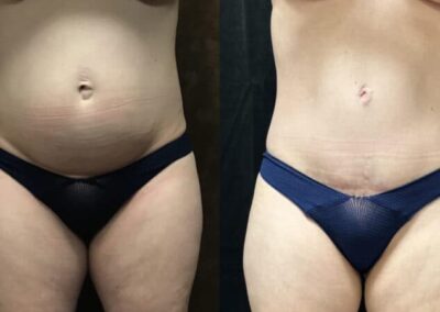 Mommy Makeover before and after photo