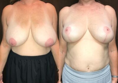 Breast Reduction Surgery before and after photos