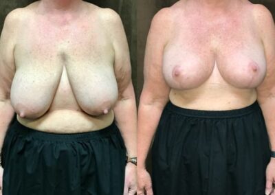 Breast Lift (Mastopexy) before and after photo