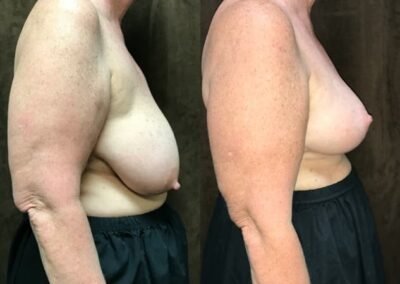 Breast Lift (Mastopexy) before and after photo