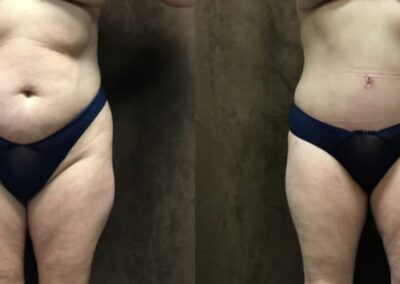 Tummy Tuck before and after photo