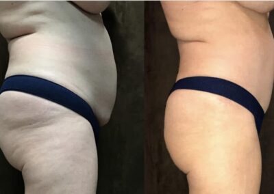 Tummy Tuck before and after photo