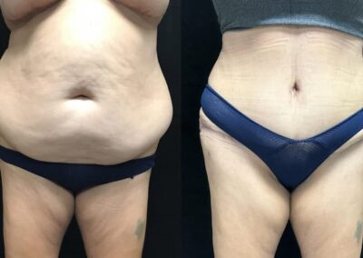 Tummy Tuck before and after photo