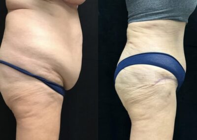 Tummy Tuck before and after photo