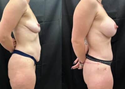 Mommy Makeover before and after photo