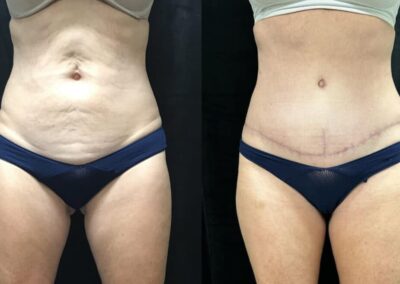 Tummy Tuck before and after photo