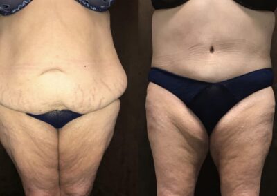 Tummy Tuck before and after photo