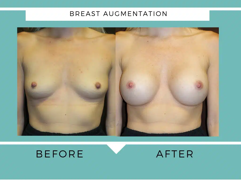 Breast augmentation before and after photo