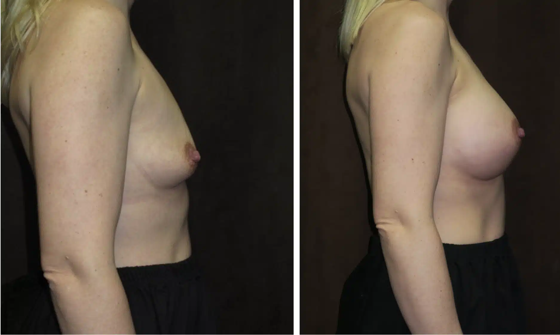 Patient 2: Before and After Breast Augmentation