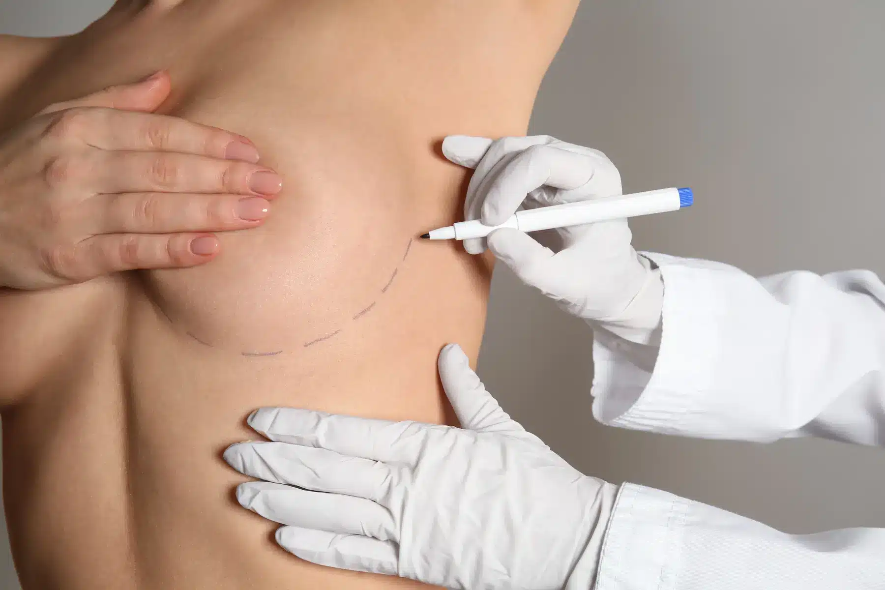 Doctor drawing marks on female breast before cosmetic surgery